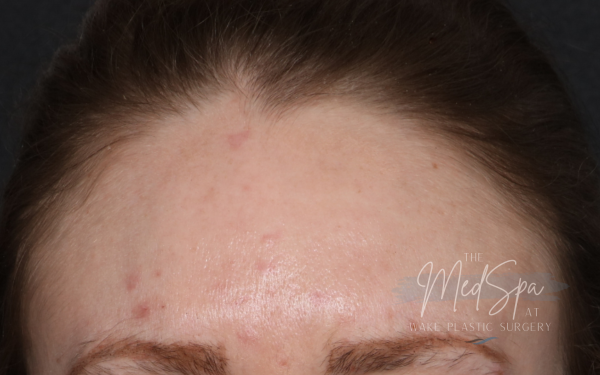 Botox-Patient-5 | After Botox