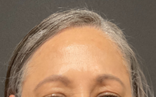 Patient-12 | After Botox