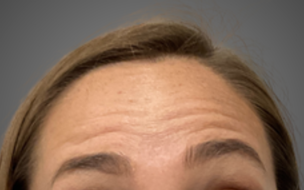 Botox-Patient-14 | Before Botox