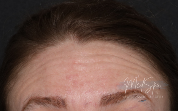 Botox-Patient-5 | Before Botox