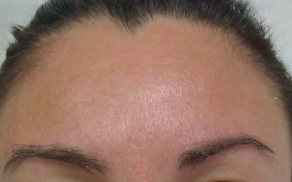Botox-Patient-9 | After Botox