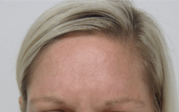Patient-9 | Before Botox