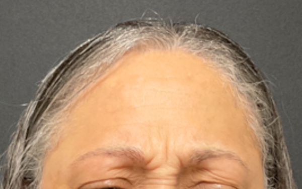 Patient-12 | Before Botox