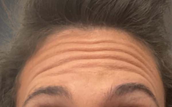 Botox-Patient-13 | Before Botox
