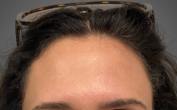 Botox-Patient-13 | After Botox