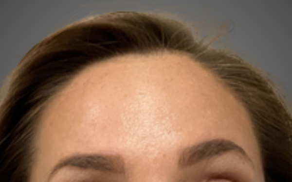 Botox-Patient-14 | After Botox
