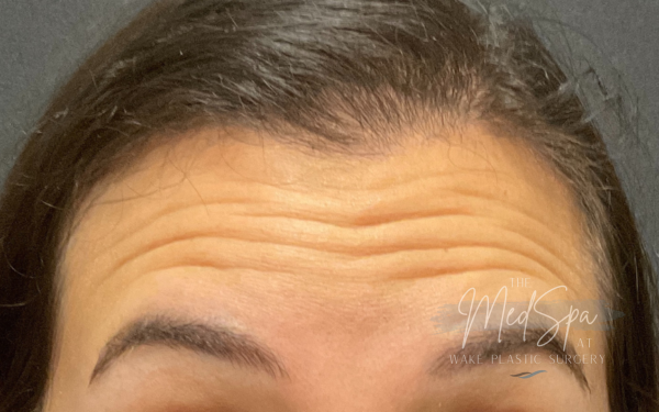Botox-Patient-3 | Before Botox