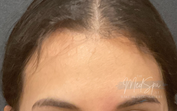 Botox-Patient-3 | After Botox
