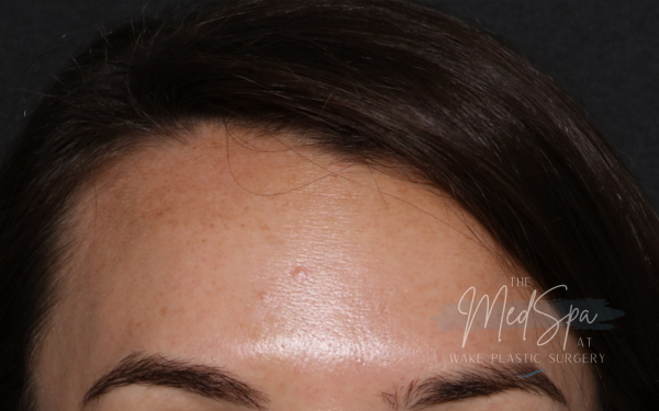 Botox-Patient-6 | After Botox