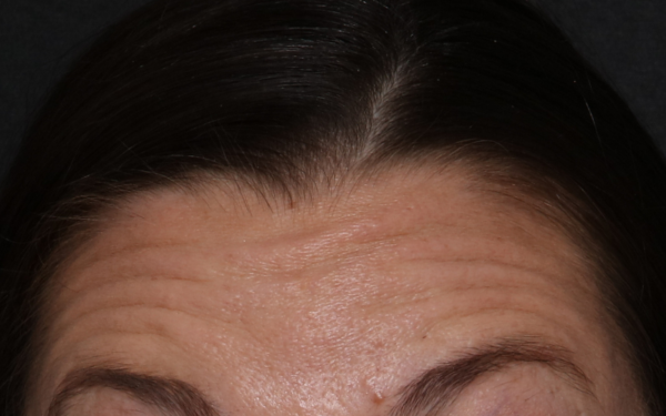 Botox-Patient-7 | Before Botox