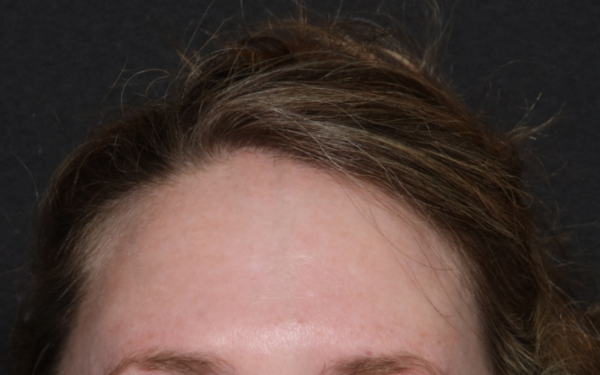 Botox-Patient-8 | After Botox
