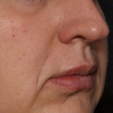 Cheek-Filler-Patient-1 | After Dermal Filler
