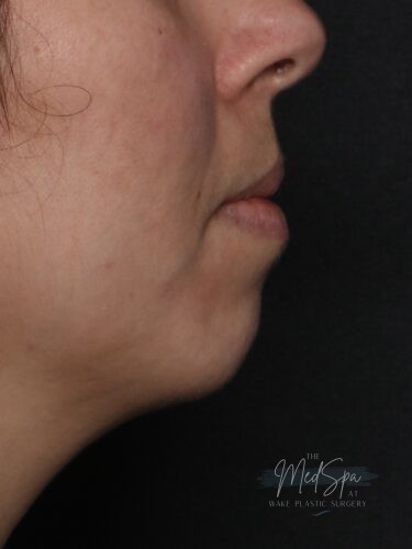 Chin filler before