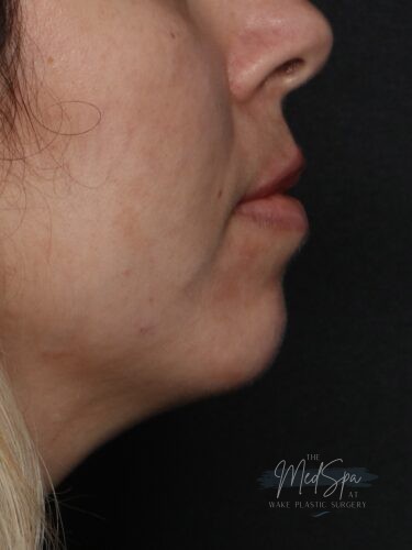 Chin filler after