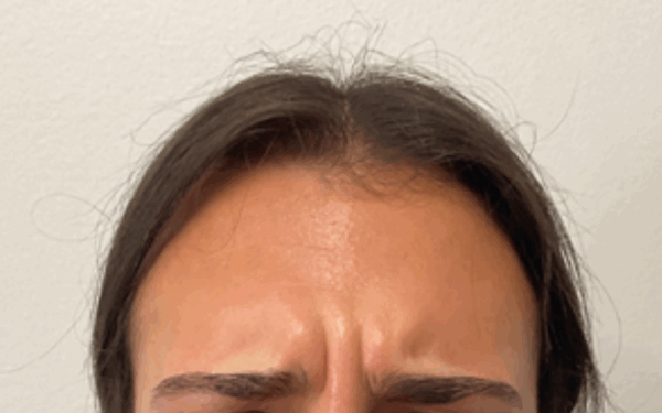 Patient-2 | Before Dysport