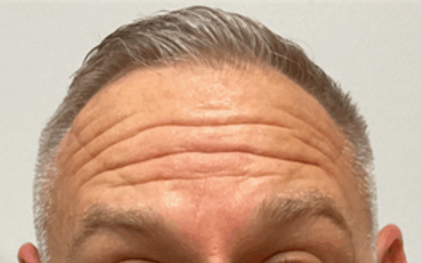 Patient-11 | Before Botox