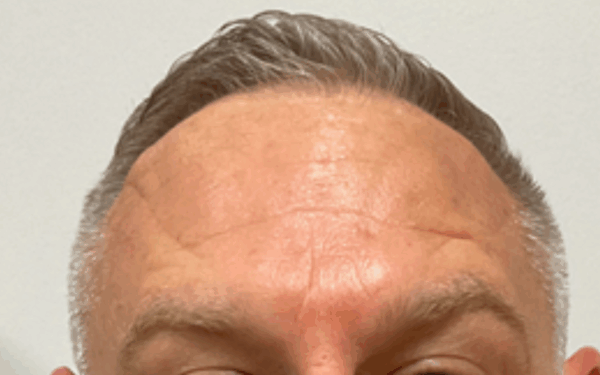 Patient-11 | After Botox