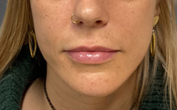 Patient-20 | Before Dermal Filler