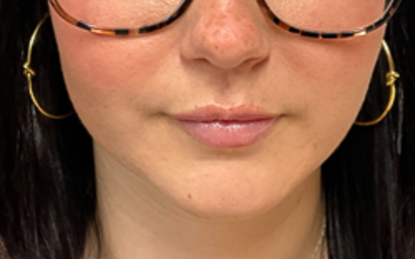 Patient-21 | After Dermal Filler