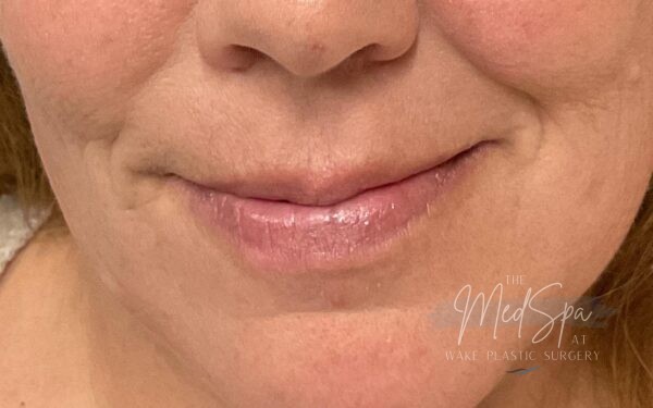 Lip-Filler-Patient-10 | Before Dermal Filler