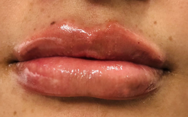 Lip-Filler-Patient-12 | After Dermal Filler