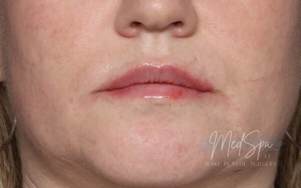 Lip filler after picture