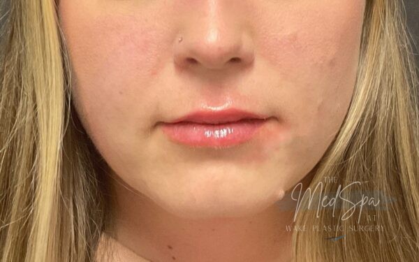 Lip-Filler-Patient-11 | After Dermal Filler