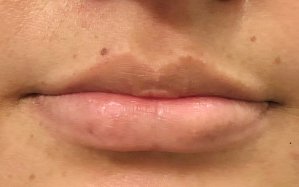 Lip-Filler-Patient-12 | Before Dermal Filler