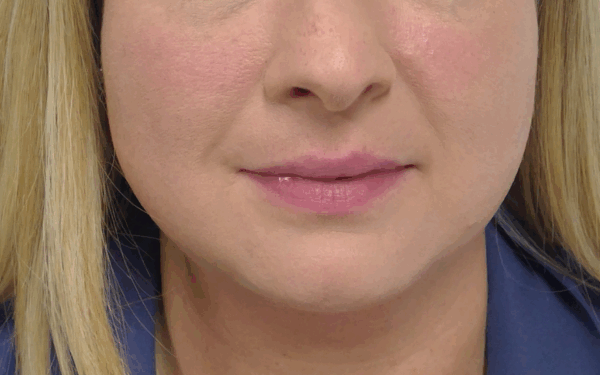 Patient-16 | Before Dermal Filler
