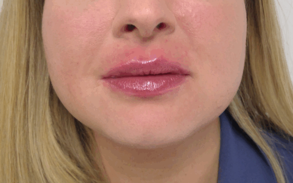 Patient-16 | After Dermal Filler