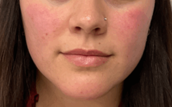 Patient-17 | Before Dermal Filler