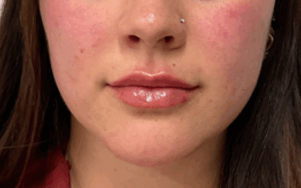Patient-17 | After Dermal Filler
