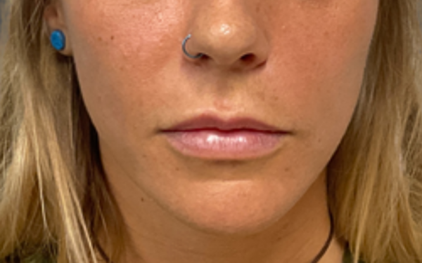 Patient-20 | After Dermal Filler