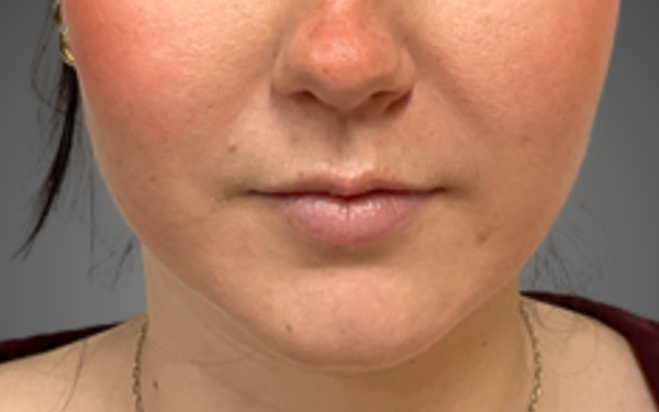 Patient-21 | Before Dermal Filler