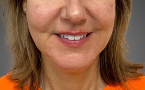 Patient-22 | Before Dermal Filler