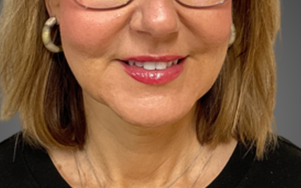 Patient-22 | After Dermal Filler