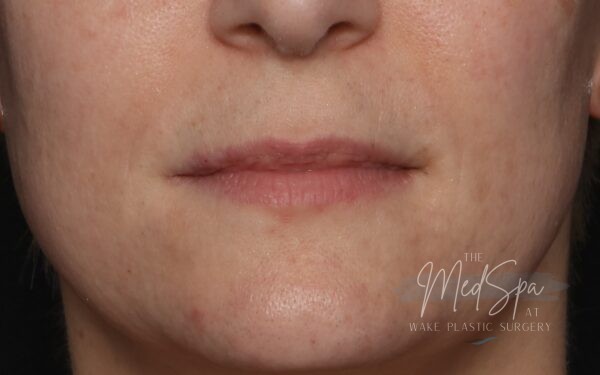 Lip filler before picture
