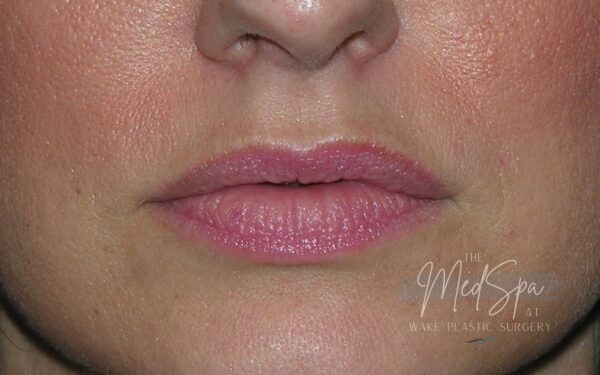 Lip-Filler-Patient-8 | Before Dermal Filler