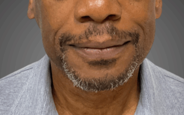 Patient-19 | Before Dermal Filler