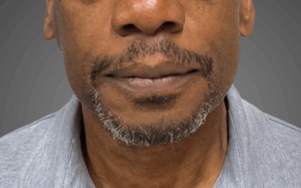 Patient-19 | After Dermal Filler