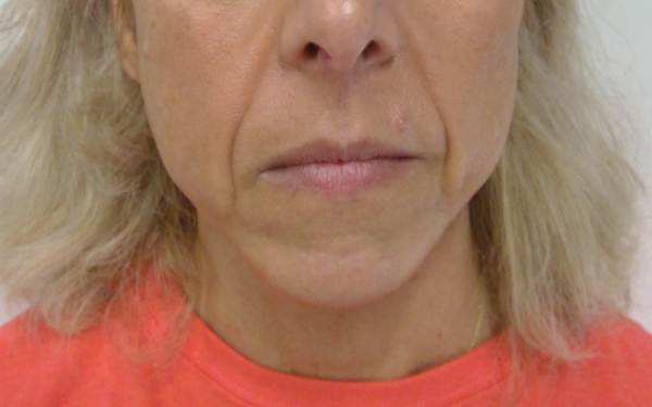 Nasolabial-Fold-Filler-Patient-1 | Before Dermal Filler