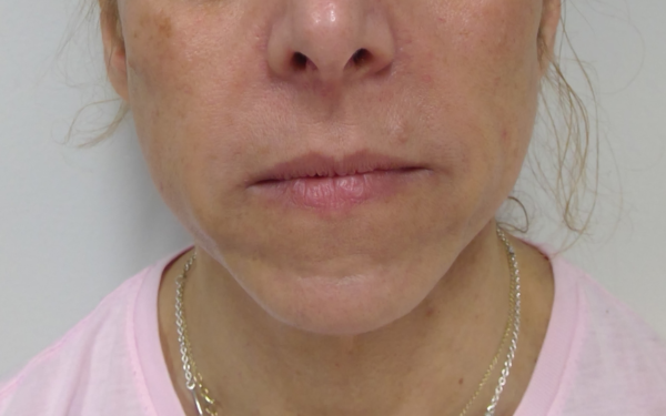 Nasolabial-Fold-Filler-Patient-1 | After Dermal Filler