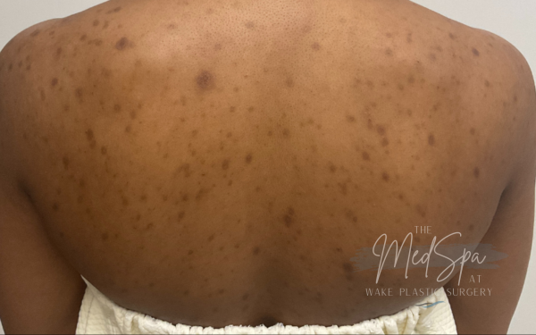 Perfect-Peel-Patient-2 | Before Chemical Peel