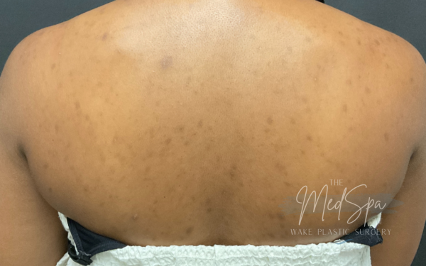Perfect-Peel-Patient-2 | After Chemical Peel