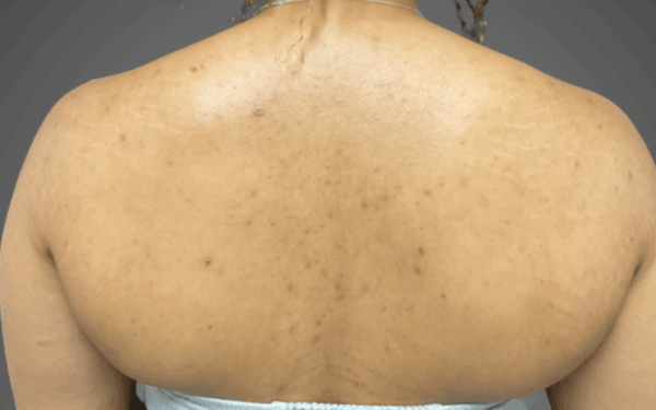 Patient-3 | Before Chemical Peel