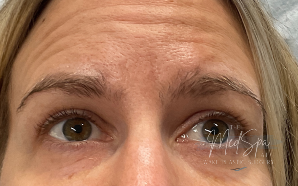 Undereye-Filler-1 | Before Dermal Filler
