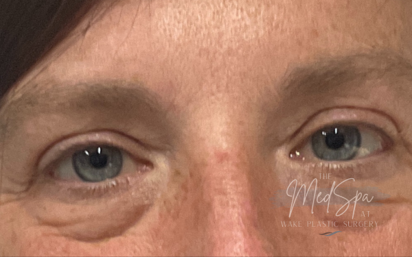Undereye-Filler-Patient-2 | Before Dermal Filler