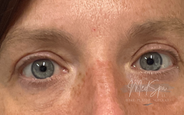 Undereye-Filler-Patient-2 | After Dermal Filler