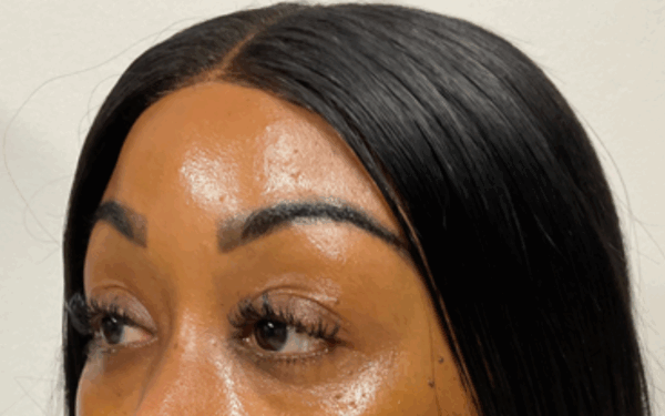 Patient-17 | Before Dermal Filler
