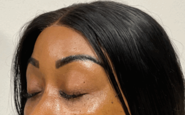 Patient-17 | After Dermal Filler